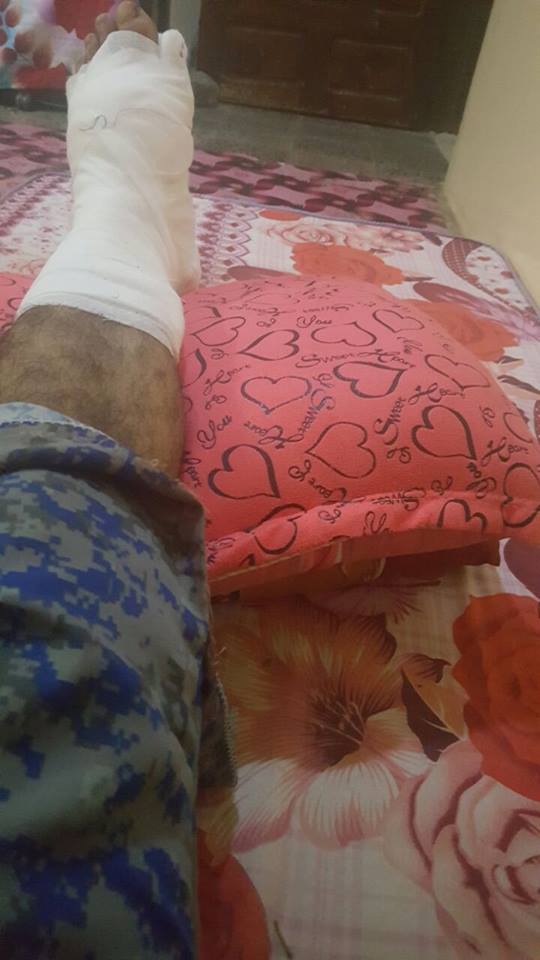 One of Mohammeds legs still healing today