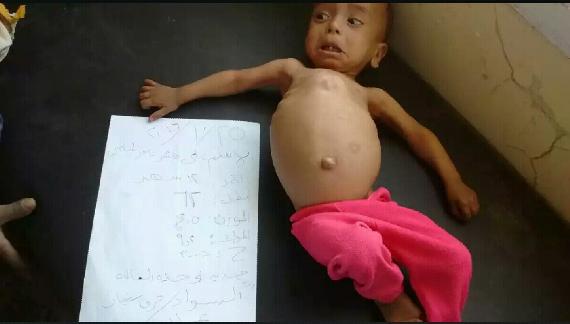 A young child receiving aid for severe malnutrition.