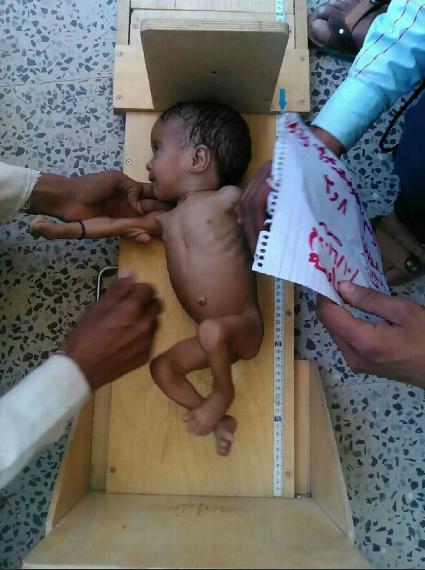 Another young child receiving aid for severe malnutrition.